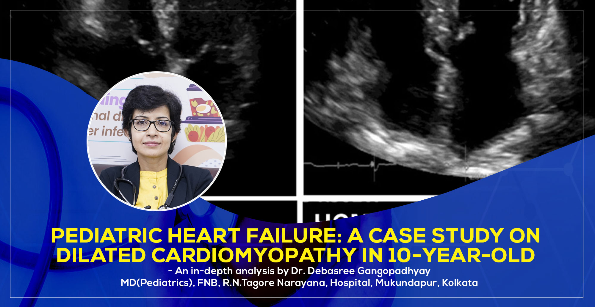 Pediatric Heart Failure: A Case Study on Dilated Cardiomyopathy in 10-Year-Old by Dr. Debasree Gangopadhyay, best Padiatric Cardiologist in Kolkata