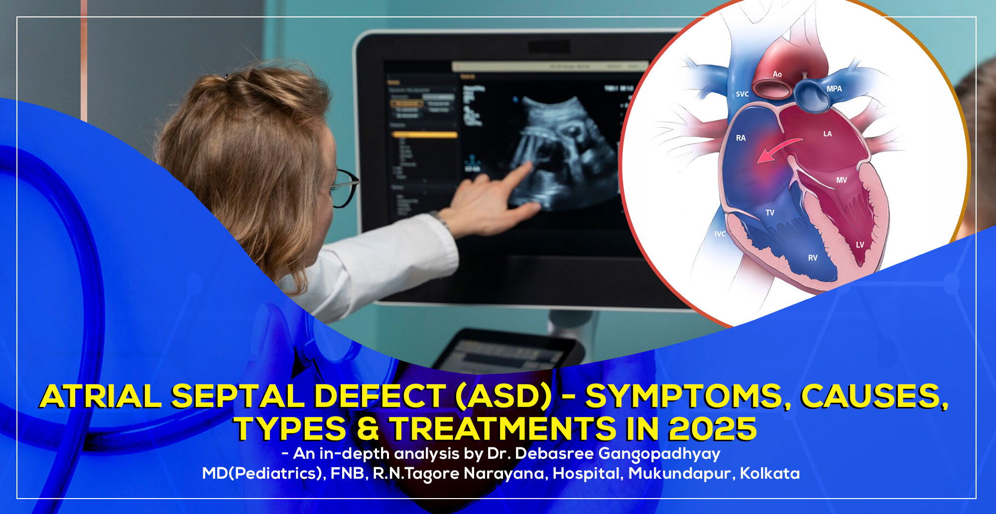 Atrial Septal Defect (ASD) - Symptoms, Causes, Types & Treatments in 2025: An Easy Guide for Parents' a by Dr. Debasree Gangopadhyay, pediatric cardiologist (MD), Narayana Hospital, Mukundapur, Kolkata.